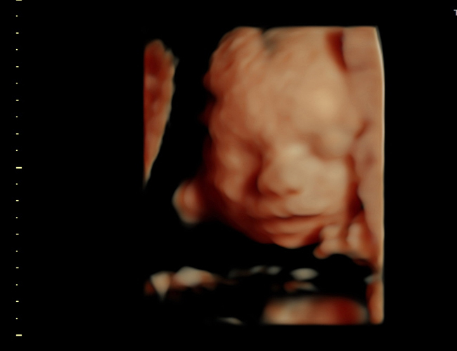 3D ultrasound image at 25 weeks
